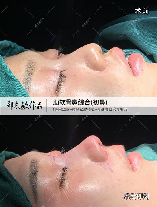 郑志敏医生半肋鼻综合术后即可