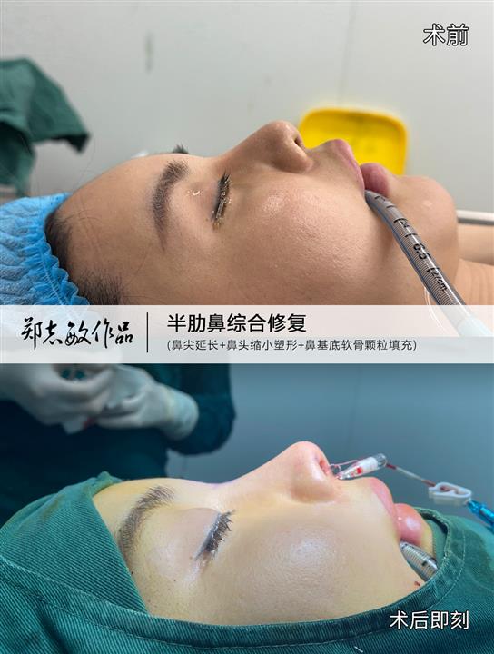 郑志敏医生半肋鼻综合臃肿大鼻头修复