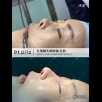 郑志敏医生全肋软骨修复挛缩鼻案例