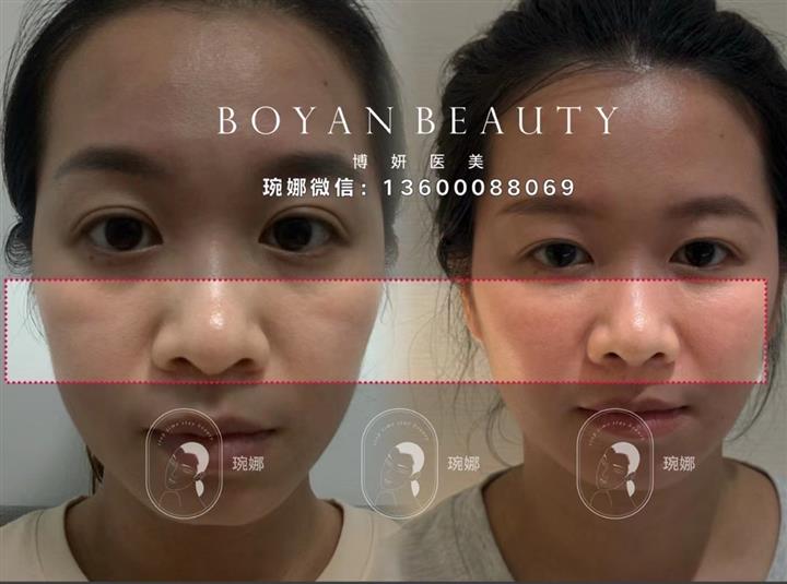 深圳印第安纹剥离