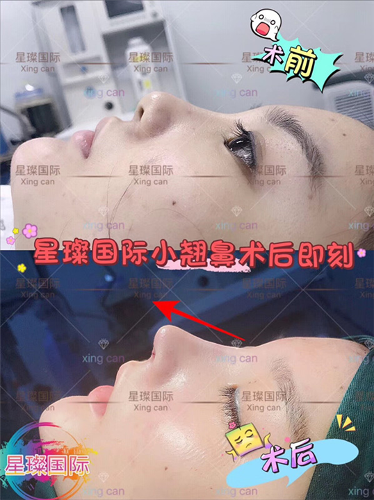 上海星璨国际整形 网红同款翘鼻打造 