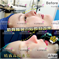 上海鼻部整形失败修复医院哪家好？ 