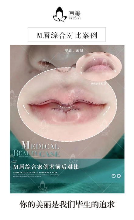 南昌M唇综合案例