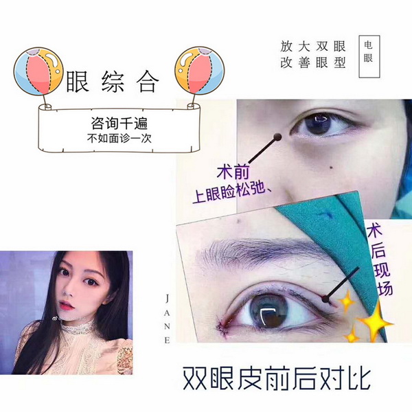 湖南做双眼皮的医生哪个好 
