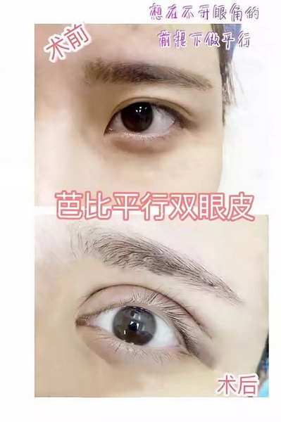 益阳眼综合整形多少钱 