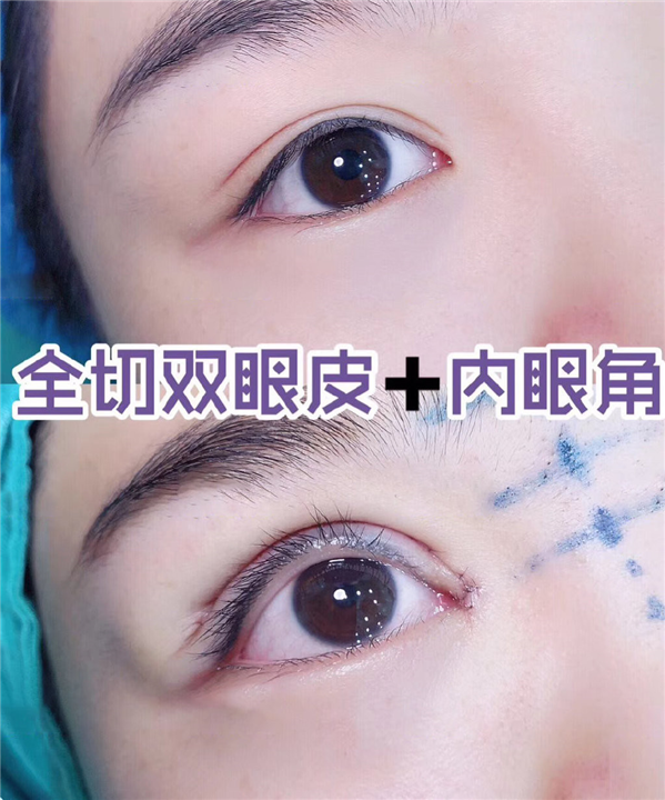 益阳双眼皮整形 