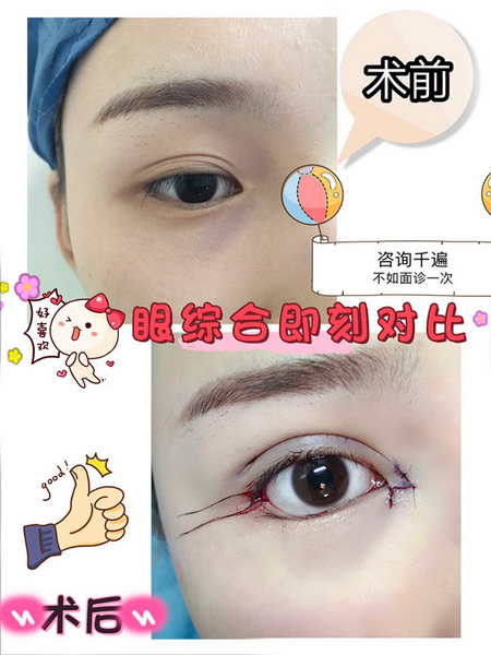 陈巧医生眼综合整形术后即刻 