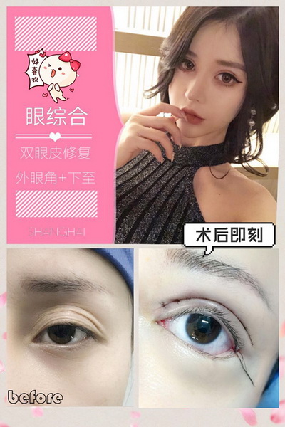 益阳双眼皮修复 