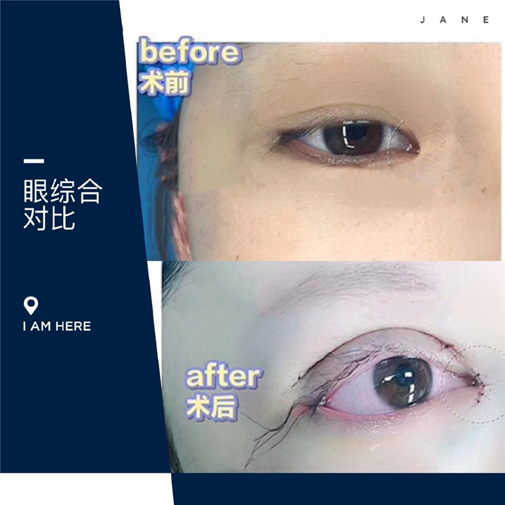 益阳双眼皮整形 