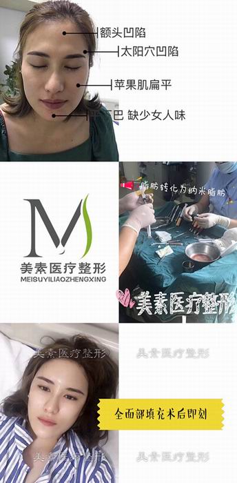 自体脂肪填充术后效果 
