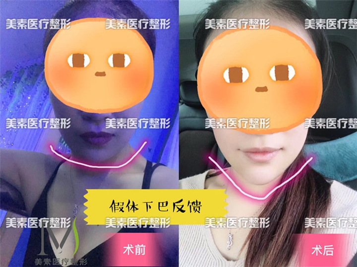 下巴 