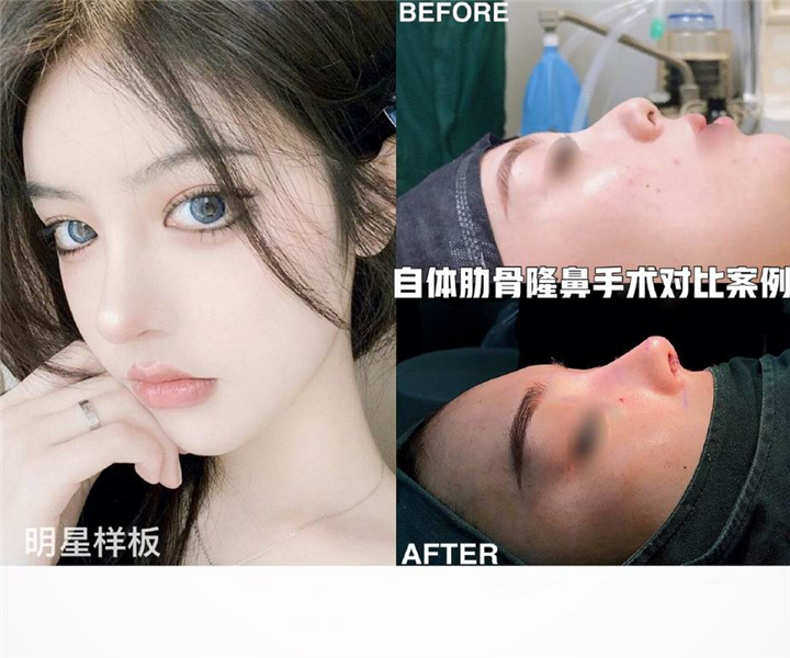 上海自体肋骨隆鼻整形