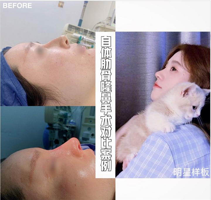 上海自体肋骨鼻综合整形
