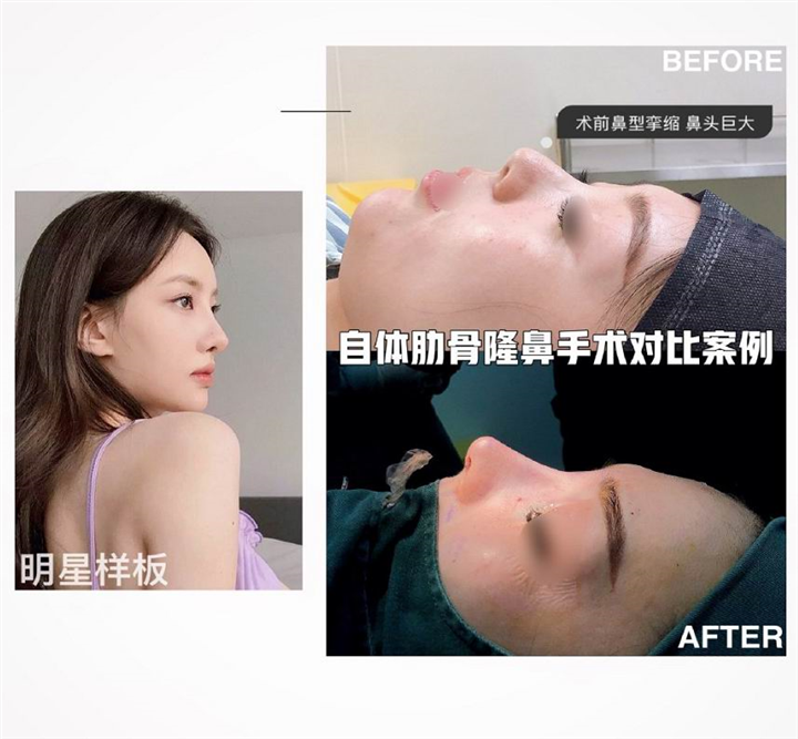 上海微加自体肋骨隆鼻对比