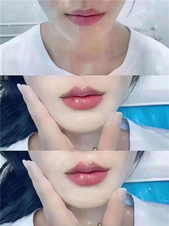 上海微加医疗玻尿酸丰唇案例