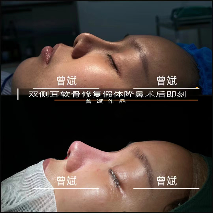 曾斌膨体隆鼻VS硅胶隆鼻，哪种隆鼻方式更适合你？