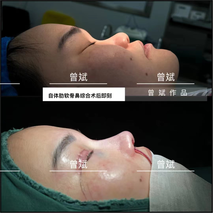 微创鼻综合整形术：告别疼痛，拥有完美鼻子