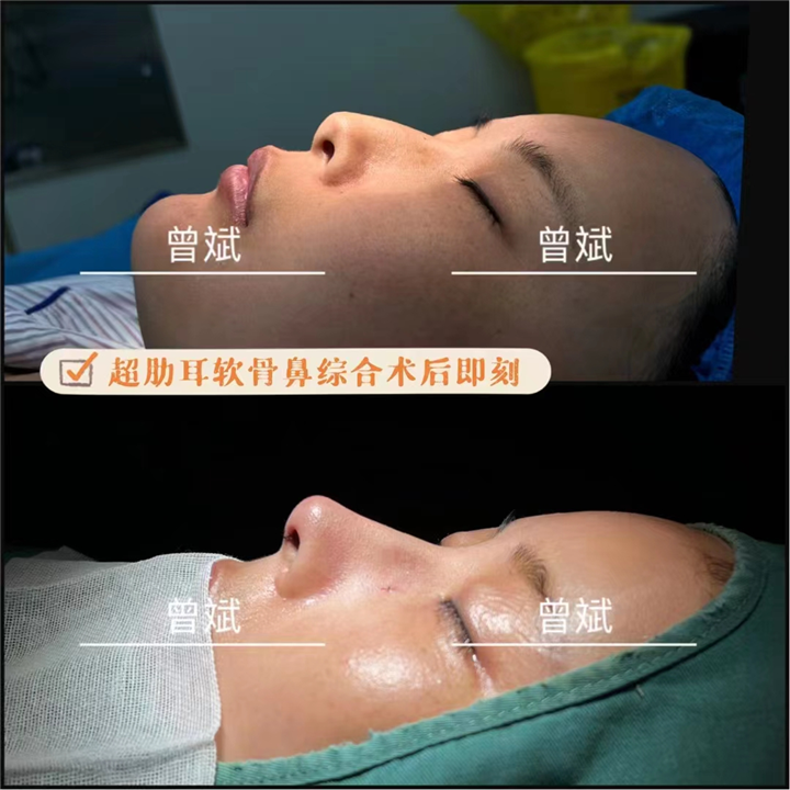 郑州鼻整形曾斌
