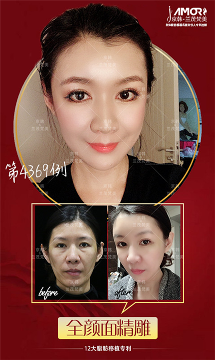 北京脂肪填充专家乔爱军 