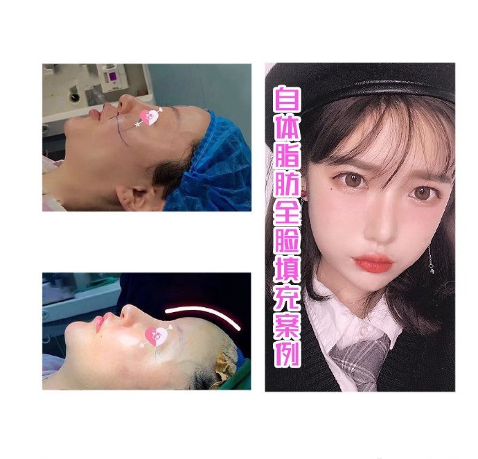 上海做自体脂肪填充价格