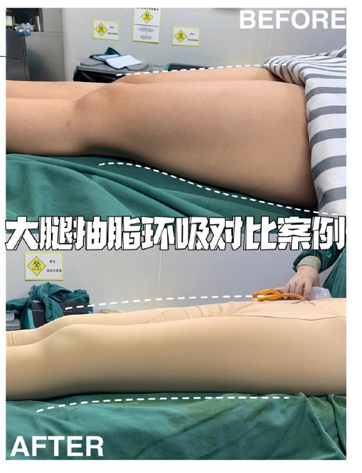 上海大腿抽脂整形