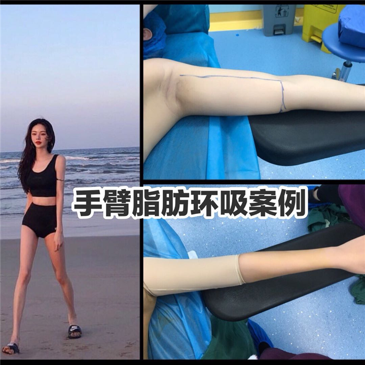 上海抽脂整形
