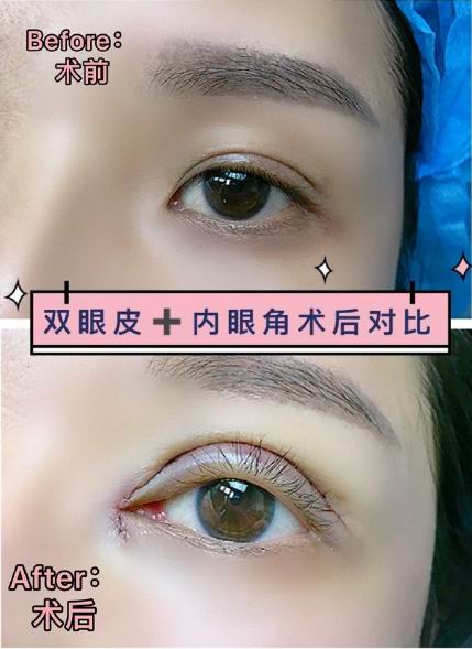 重庆双眼皮修复 