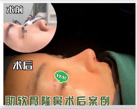 重庆鼻整形修复