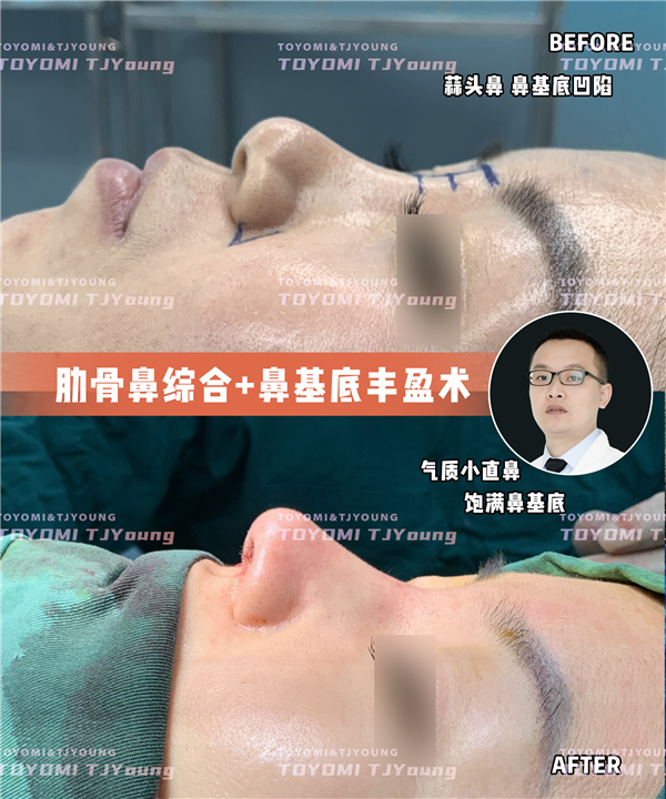 王晶-肋骨鼻+鼻基底 (3)