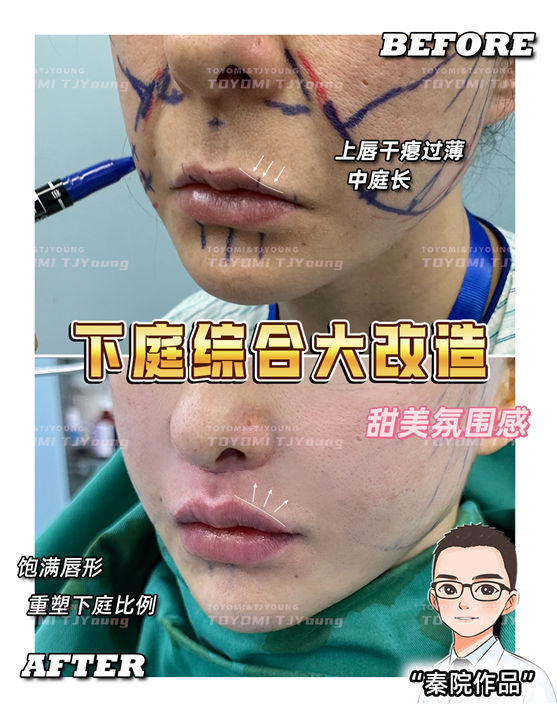 王娟-人中缩短+唇峰重塑 (3)