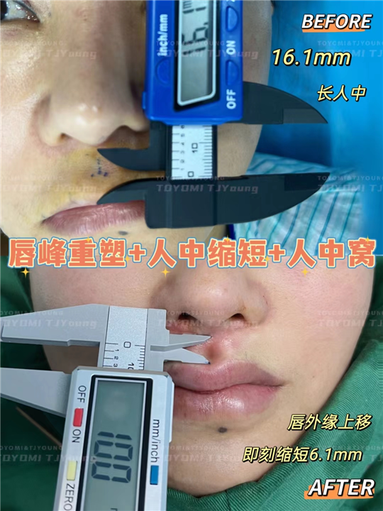 吴青-唇峰重塑+人中缩短+人中窝 (4)