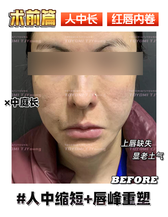 王娟-人中缩短+唇峰重塑 (1)