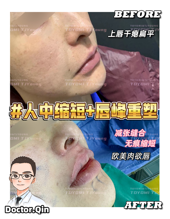 王娟-人中缩短+唇峰重塑 (2)