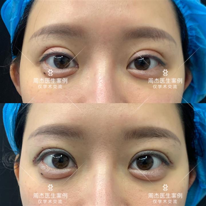 长沙周杰医生眼综合整形