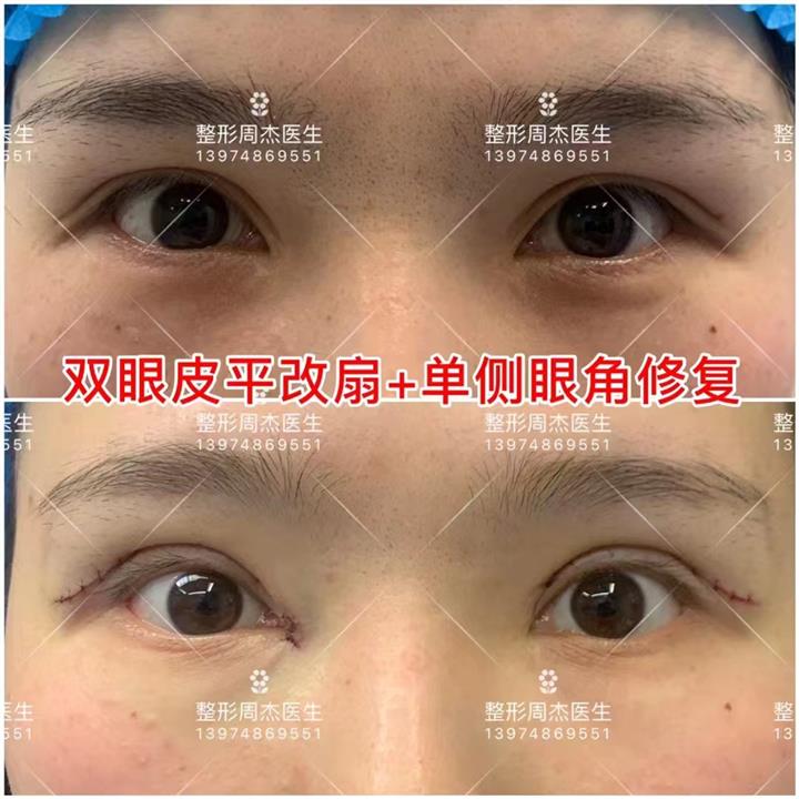 长沙周杰医生双眼皮修复