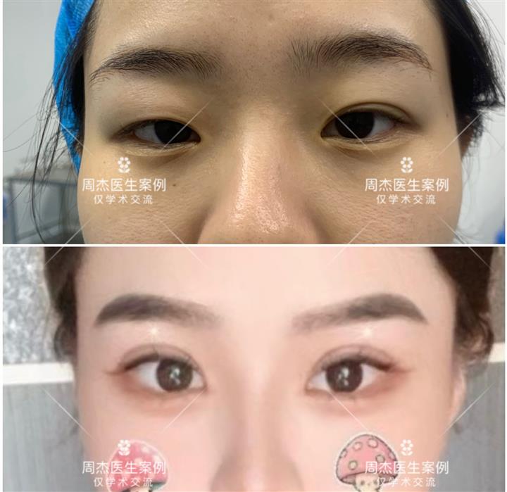 长沙周杰医生双眼皮整形