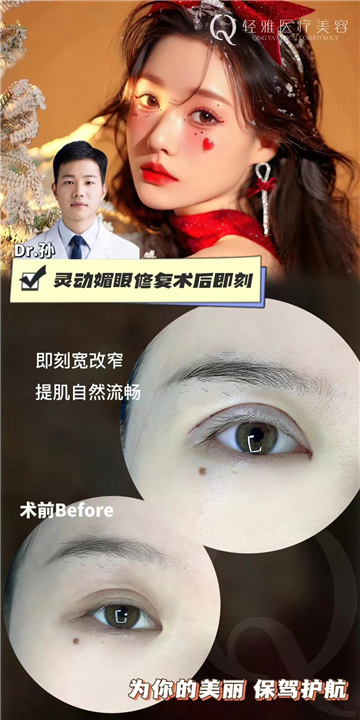 广州轻雅整形灵动媚眼修复术后即刻
