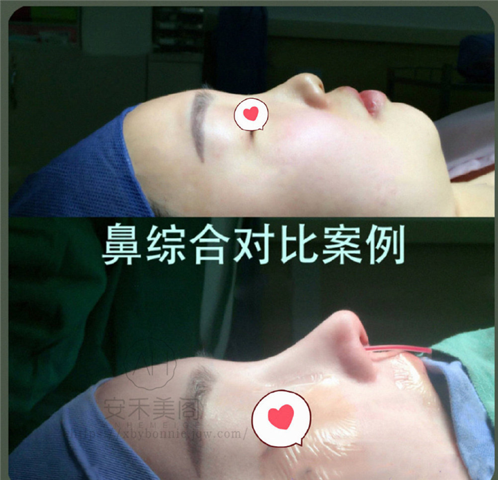 上海鼻翼基底凹陷修复整形
