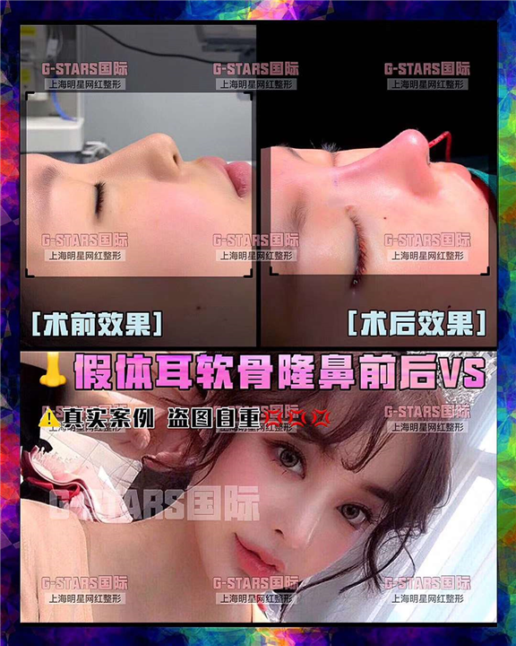 做鼻头缩小需要多少钱?费用是多少