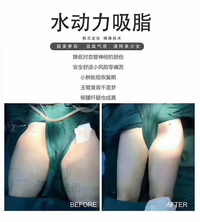 吸脂减肥后需要多长时间恢复
