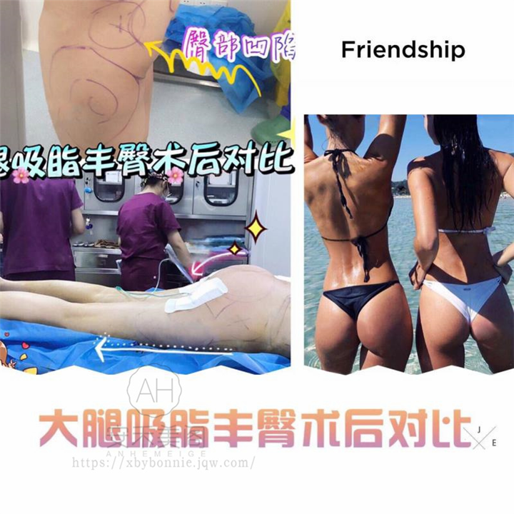 臀部吸脂多久可以坐?多久恢复