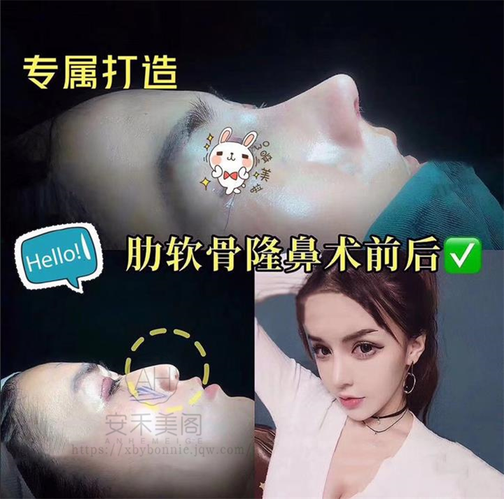 上海隆鼻哪家好