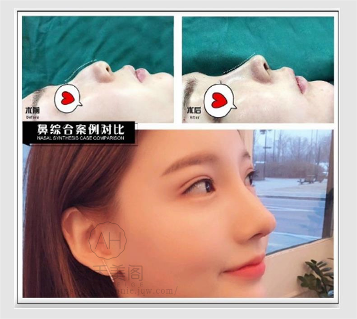 做肋软骨垫鼻尖的流程是什么?恢复时间要多久