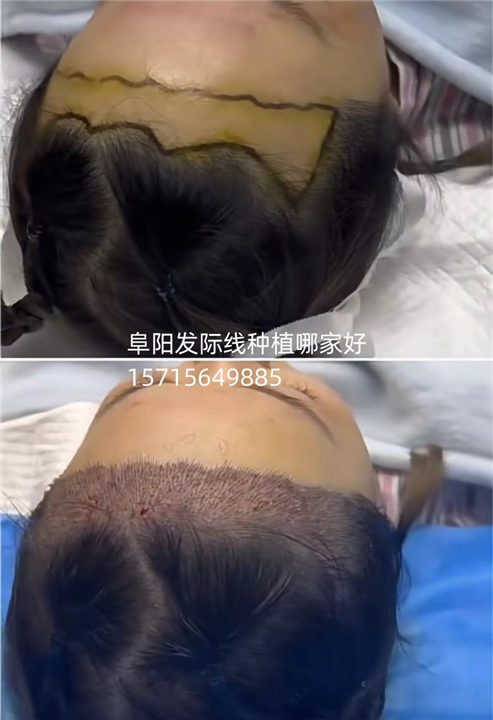 安庆头发种植