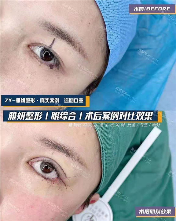 婕熹卡整形｜广州网红整形