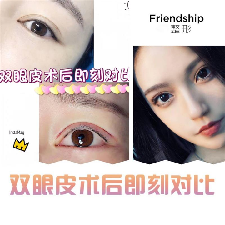 北京眼综合整形哪家专业