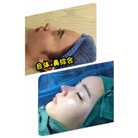 北京鼻综合整形