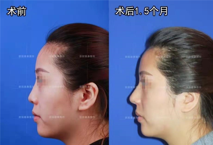 高难度鼻修复欧阳春