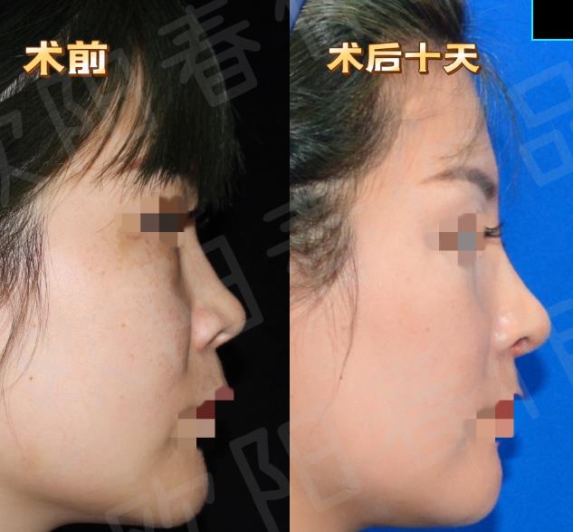 欧阳春鼻子做得怎么样
