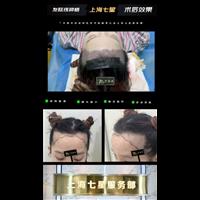?上海七星整形发际线种植术后对比